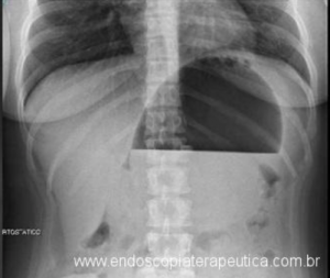 Imagem de radiografia de abdome demonstrando balão hiperinsuflado com nível líquido