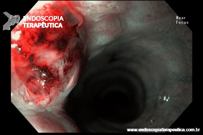 Carcinoma Neuroendócrino de Esôfago