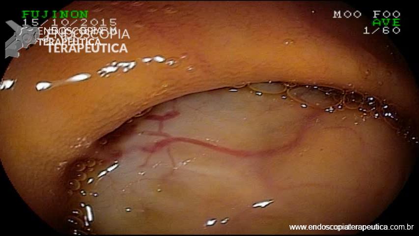 Paciente apresentando tumor estromal (GIST) em intestino delgado com apresentação clínica com hemorragia digestiva. 