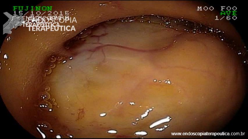Lesão subepitelial em intestino delgado em paciente com quadro de hemorragia digestiva
