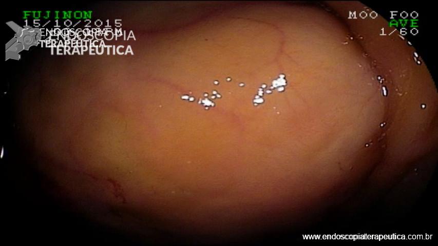 Paciente com quadro de hemorragia digestiva tendo sido identificada lesão subepitelial em duodeno distal