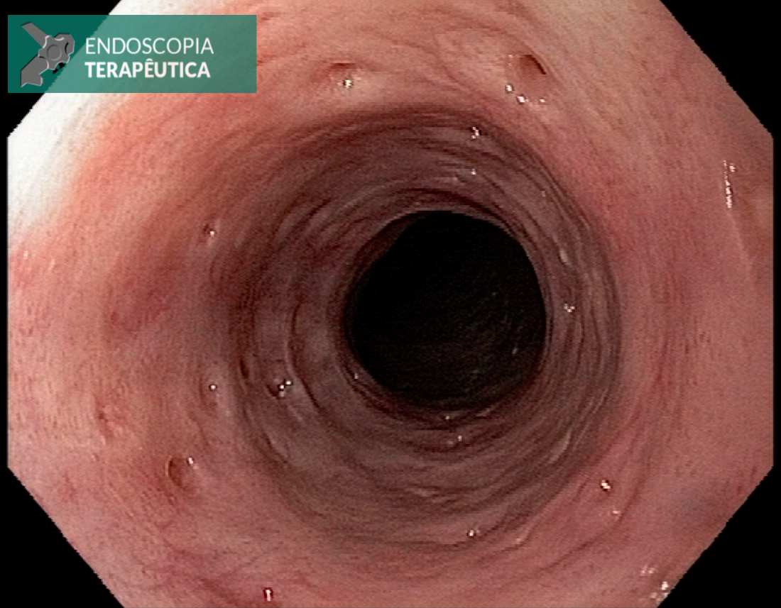 gastrectomia total por neoplasia gástrica imagem 1
