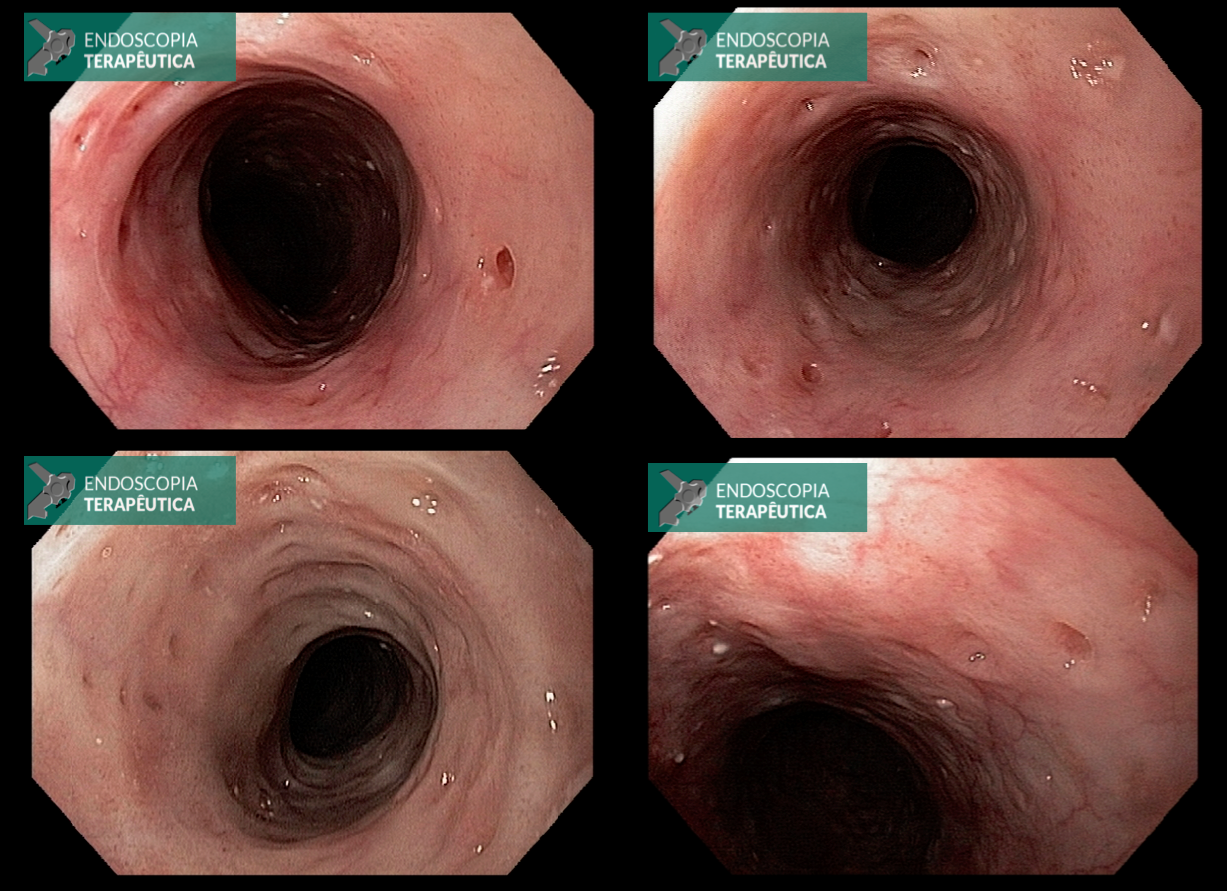 gastrectomia total por neoplasia gástrica imagem 2